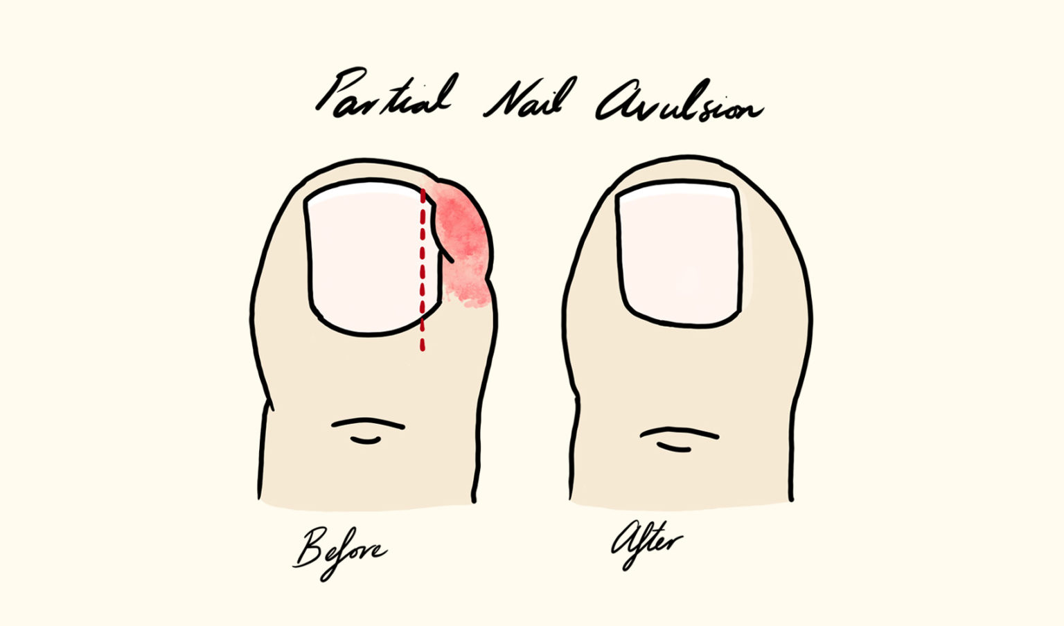 Ingrown Toenails Northern Rivers Podiatry