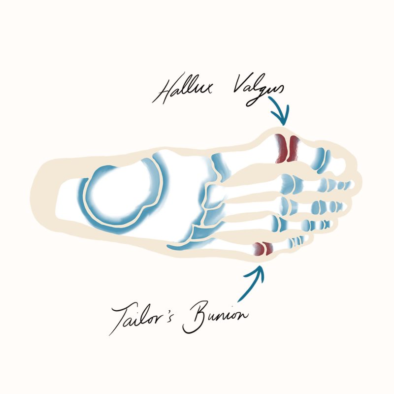 Bunions Illustration Bunions Illustration