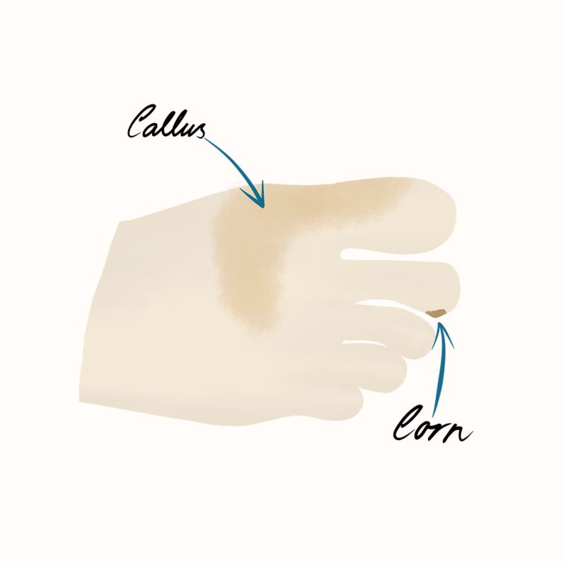 Corns and Calluses Illustration Corns and Calluses Illustration