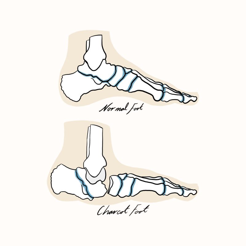 Diabetes Illustration Diabetes Illustration