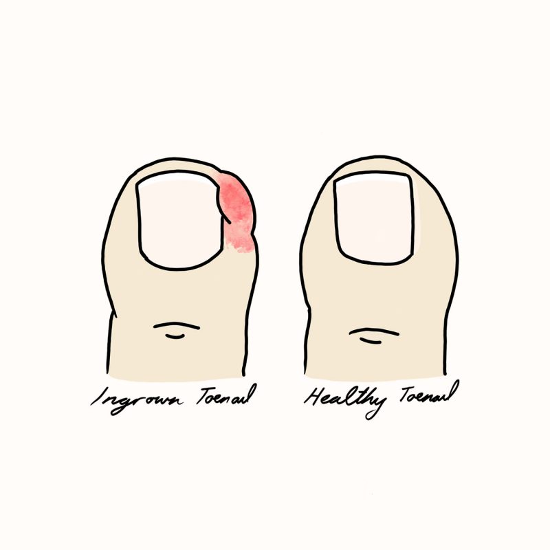 Ingrown Toenails Illustration