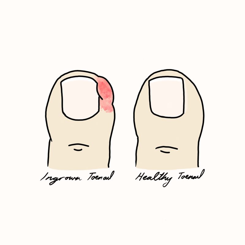 Ingrown Toenails Illustration Ingrown Toenails Illustration