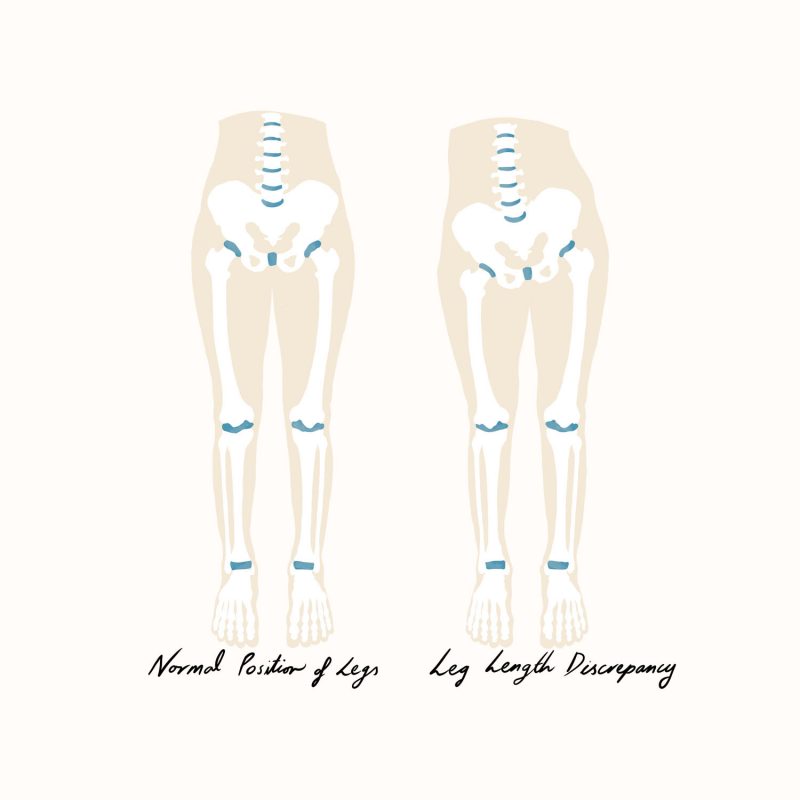 Leg Length Discrepancy Illustration