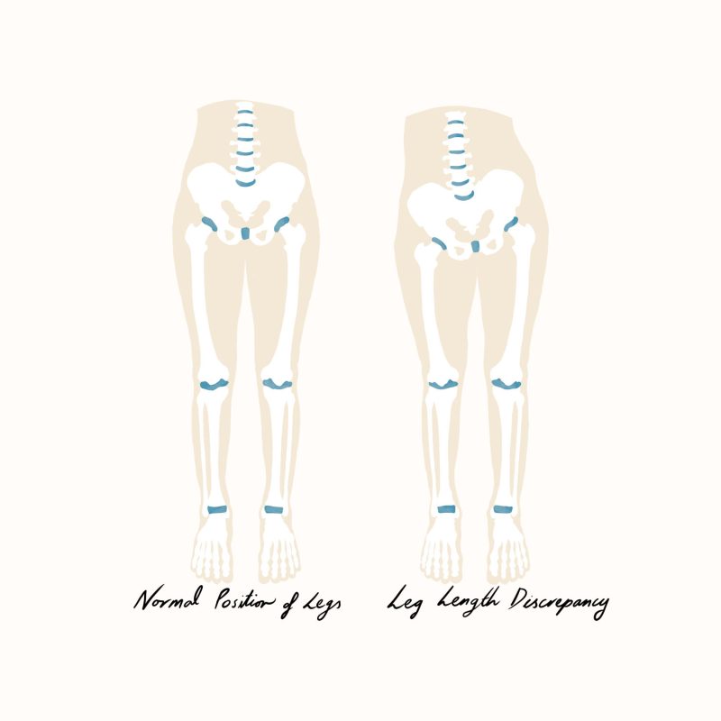 Leg Length Discrepancy Illustration Leg Length Discrepancy Illustration