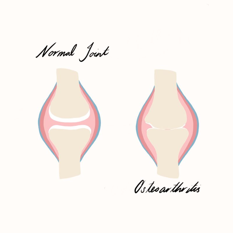 Osteoarthritis Illustration Osteoarthritis Illustration