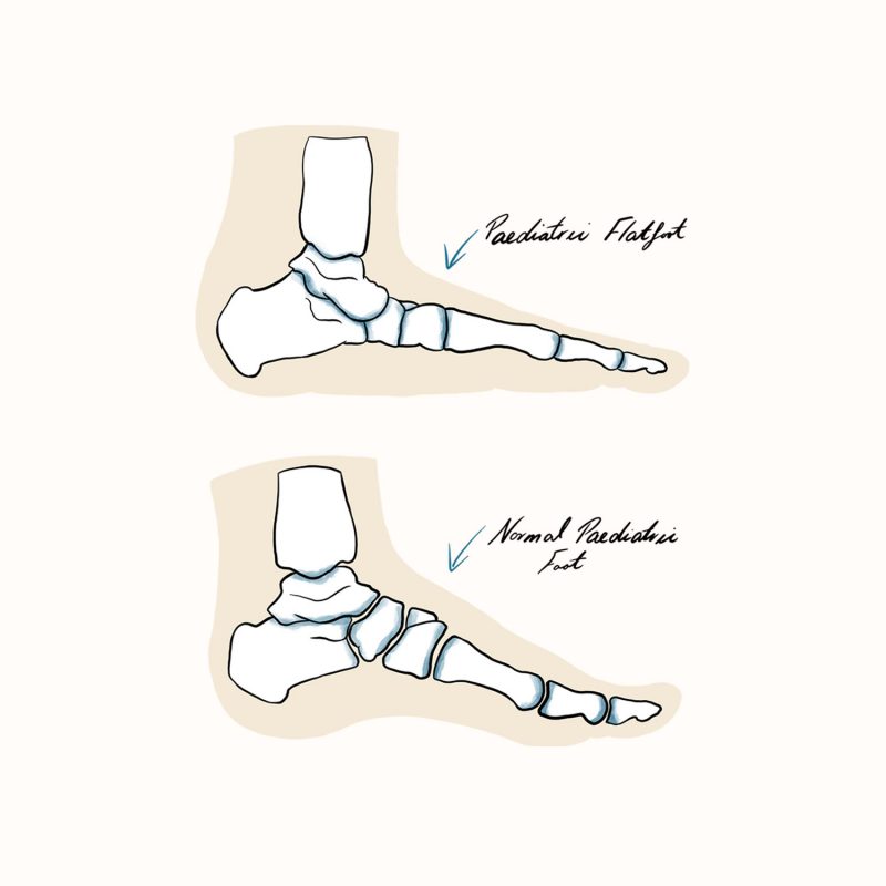 Paediatric Flat Foot Illustration