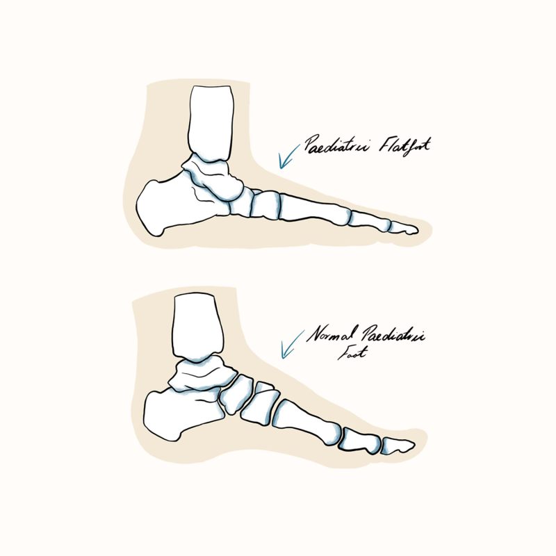 Paediatric Flat Foot Illustration Paediatric Flat Foot Illustration