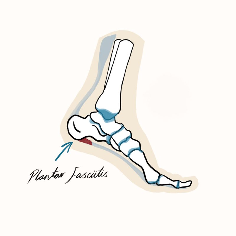 Plantar Fasciitis Illustration Plantar Fasciitis Illustration