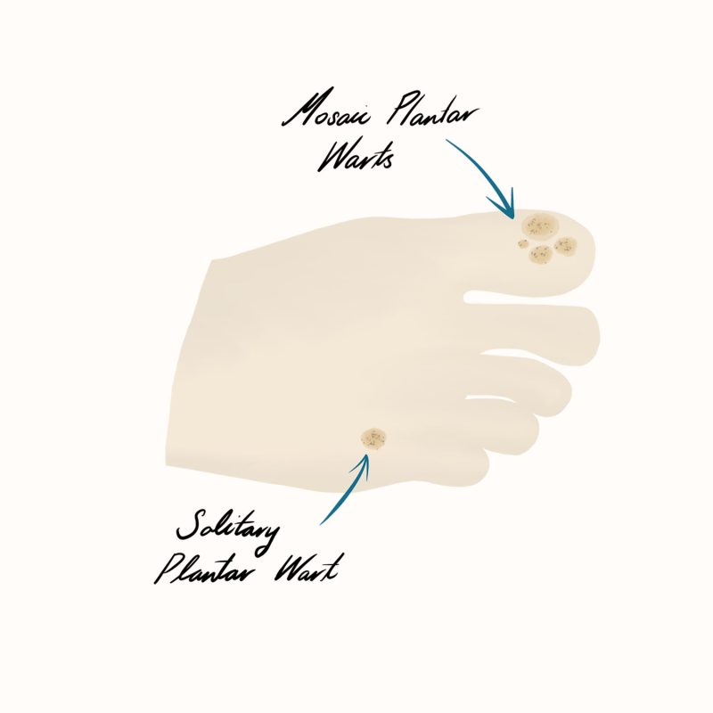 Plantar Warts Illustration Plantar Warts Illustration