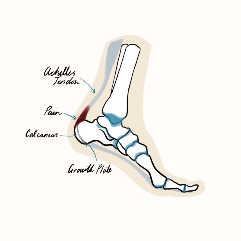 Severs Disease Illustration